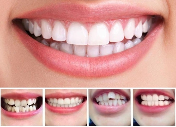 Invisible Dental Realignment Tray