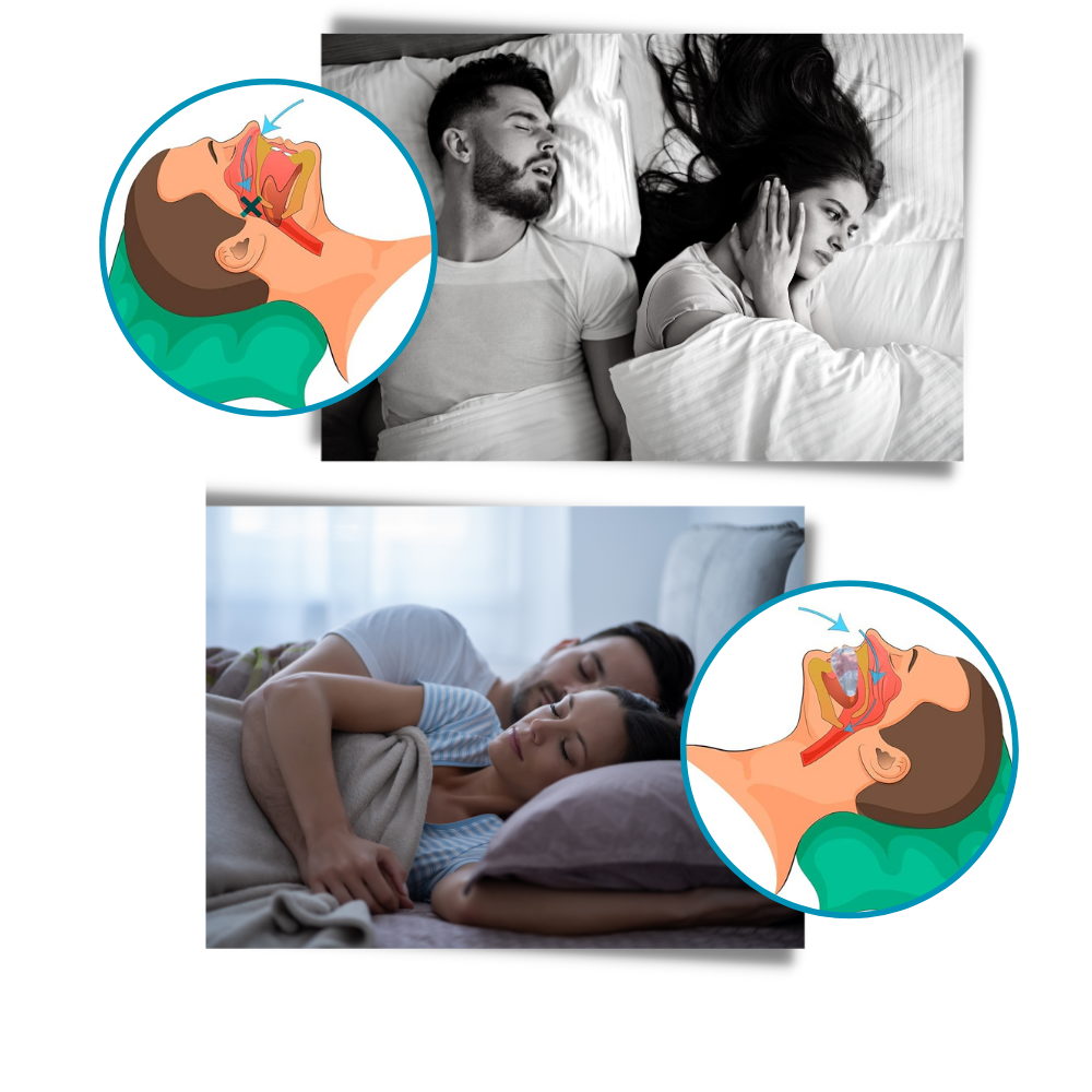 Advanced anti-snoring device