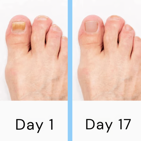 Nail Laser Fungus Device