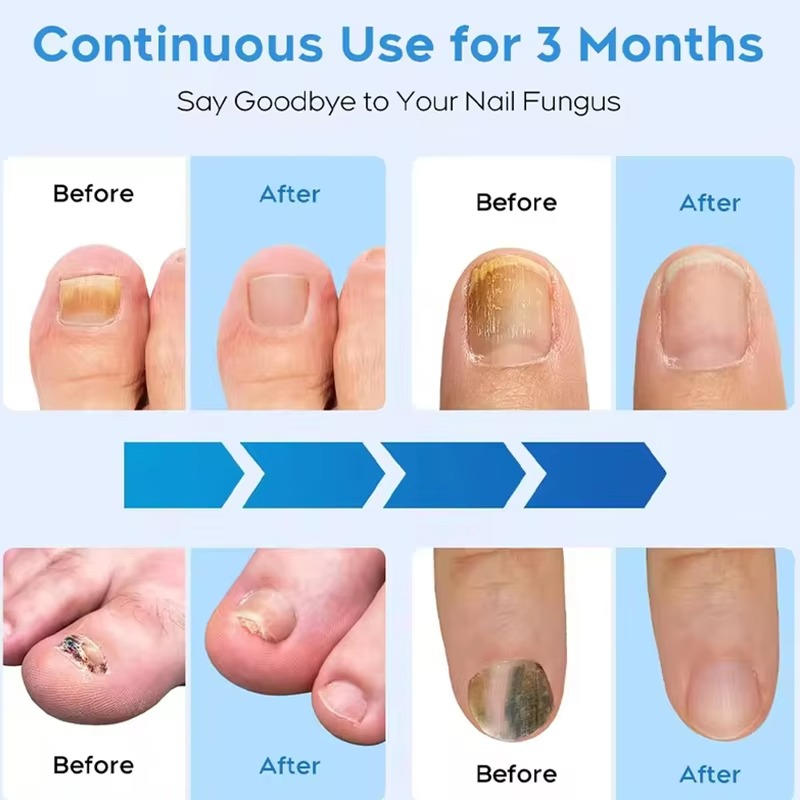 Nail Fungus Laser