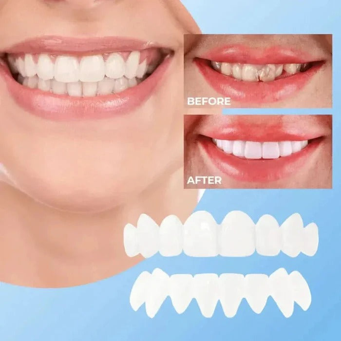 Veneers for Teeth with Natural White Finish