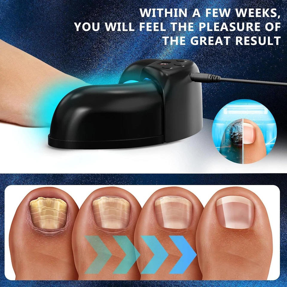 Nail Fungus Laser