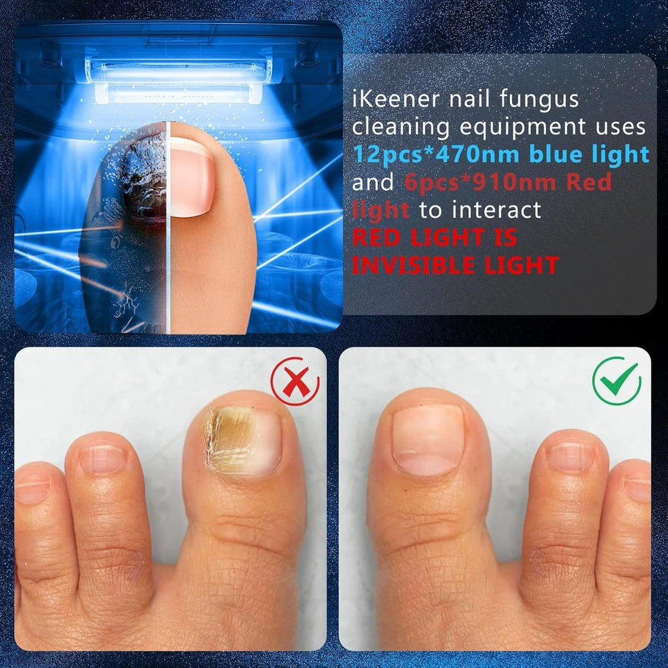 Nail Fungus Laser